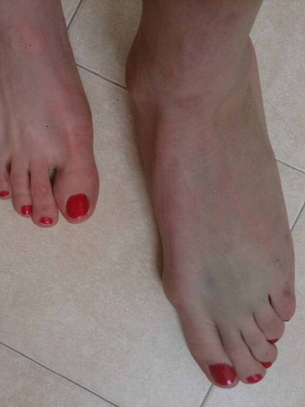 Justyna Kowalczyk - ho preso a calci capita di gamba di un tavolo, ha detto Kowalczyk sui danni del piede.  - Foto: Justyna Kowalczyk Facebook Profile /