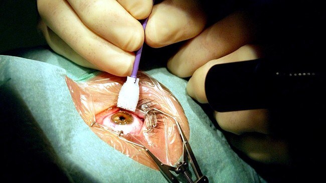 Laseroperasjon av auge. (Foto: Signe Dons, Aftenposten./Scanpix) Laseroperasjon av auge. (Foto: Signe Dons, Aftenposten./Scanpix)