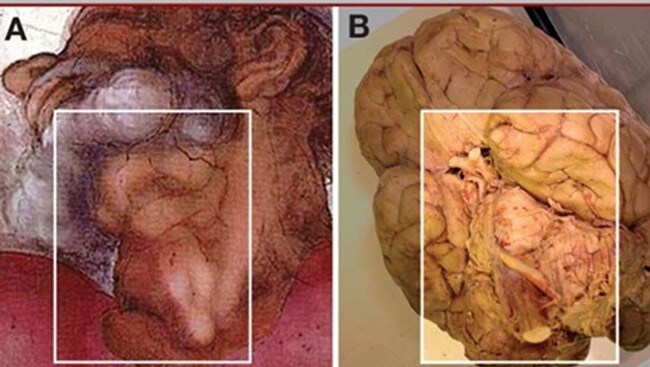 Michelangelo skjulte skisse av hjernen (Foto: Copyright (C) by the Congress of Neurological Surgeons)