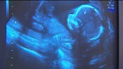 Abortstrid - Programkomiteen i Høyre har gått inn for at alvorlig sykdom hos fosteret ikke skal være en selvstendig abortgrunn. Professor ved nasjonalt senter for fostermedisin, Sturla Eik Nes, mener forslaget er kvinnefiendtlig.