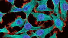 Kreft sett gjennom mikroskopet. (Foto: Thomas Deerinck, National Center for Microscopy and Imaging Research, USA/ Nikon Small World)