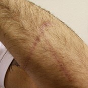Skadd arm (Foto: Tormod Strand/NRK)