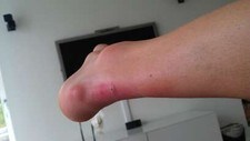Magnus Moans betente legg (Foto: Magnus Moan)