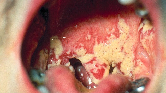 Munnsoppen Caldida albicans (Foto: CDC) Munnsoppen Caldida albicans (Foto: CDC)
