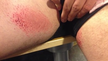 nakenrge gnagsår i skrittet nakenrge gnagsår i skrittet