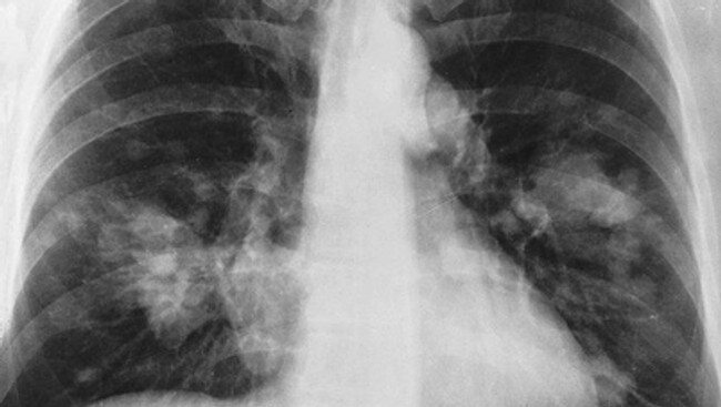 Lungekreft (Foto: National Cancer Institute) Lungekreft (Foto: National Cancer Institute)