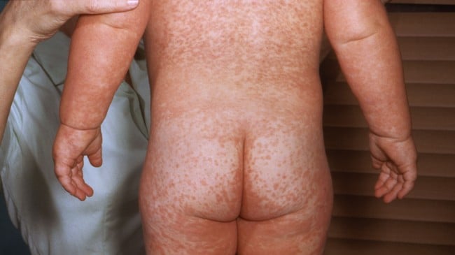 Meslinger  (Foto: CDC)