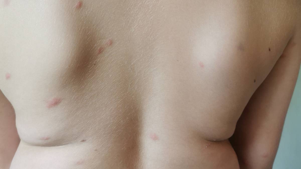 Varmt badevann gir svømmekløe: – Han så ut som en rødspette