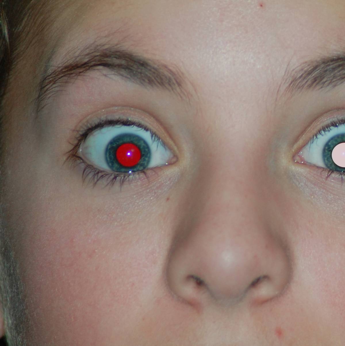 Hvit pupill på barn kan være svulst – NRK Livsstil – Tips, råd og innsikt