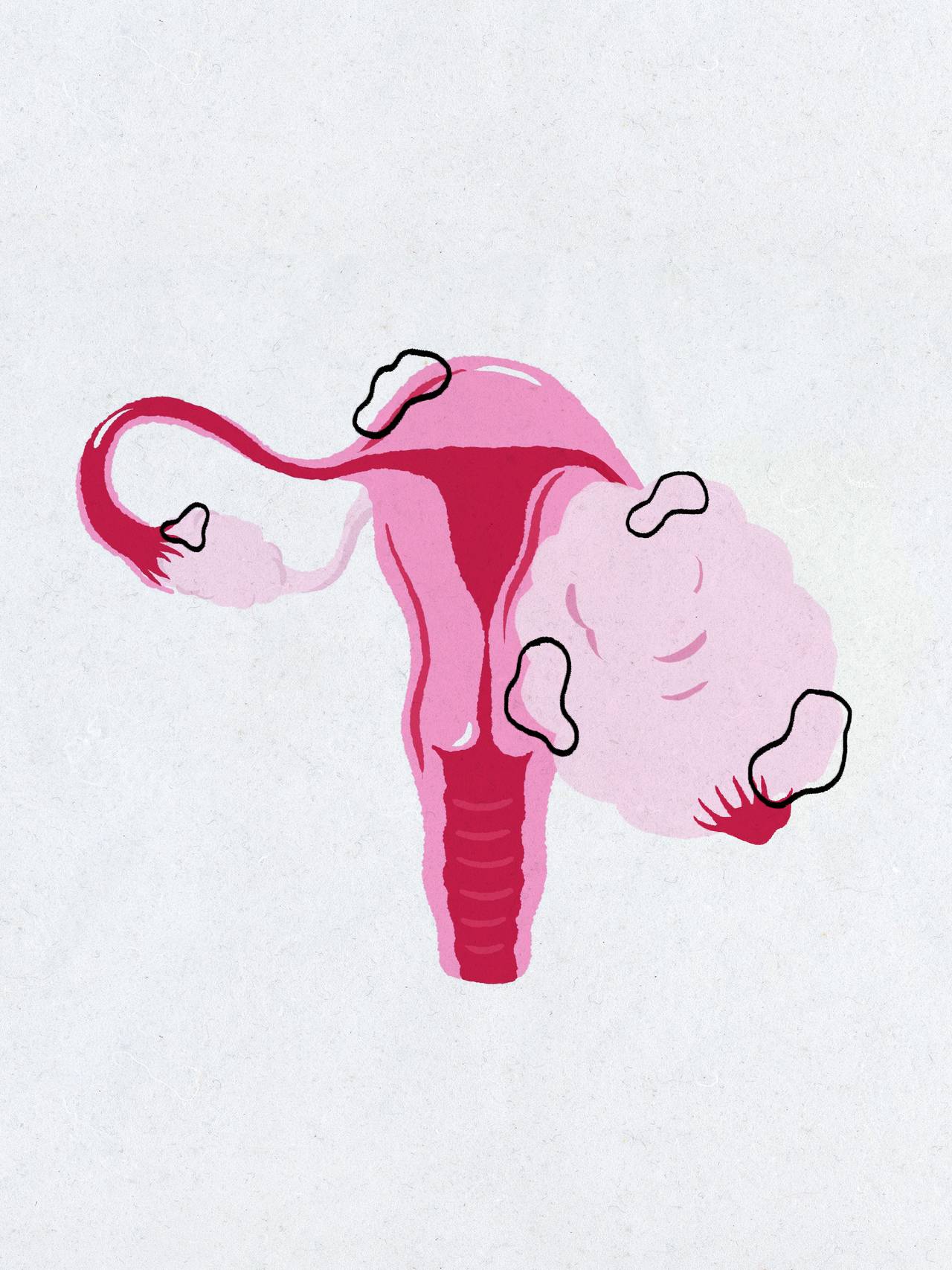 Illustrasjon av cycste som har vokst til dobbel størrelse i eggstokk med endometriosevev