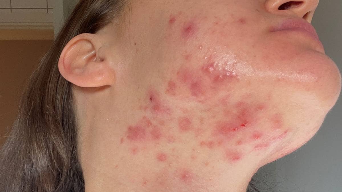 Brukte år på å bli kvitt kvisene – fastlegen ble redningen