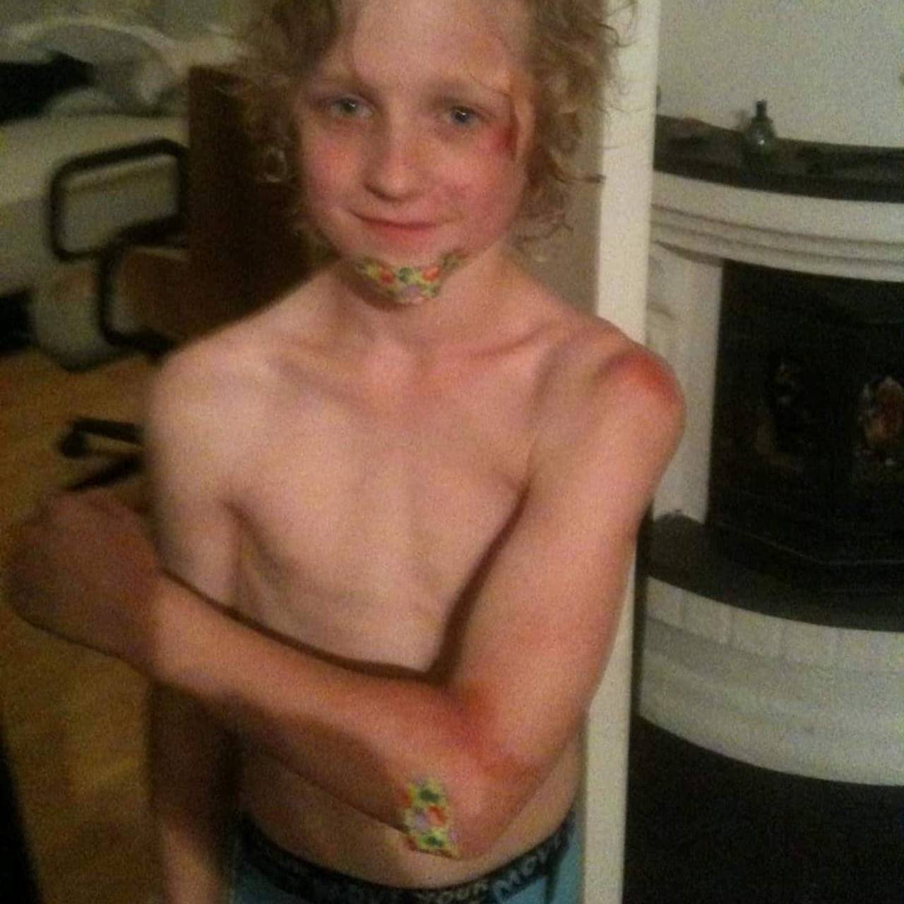Skrubbsår