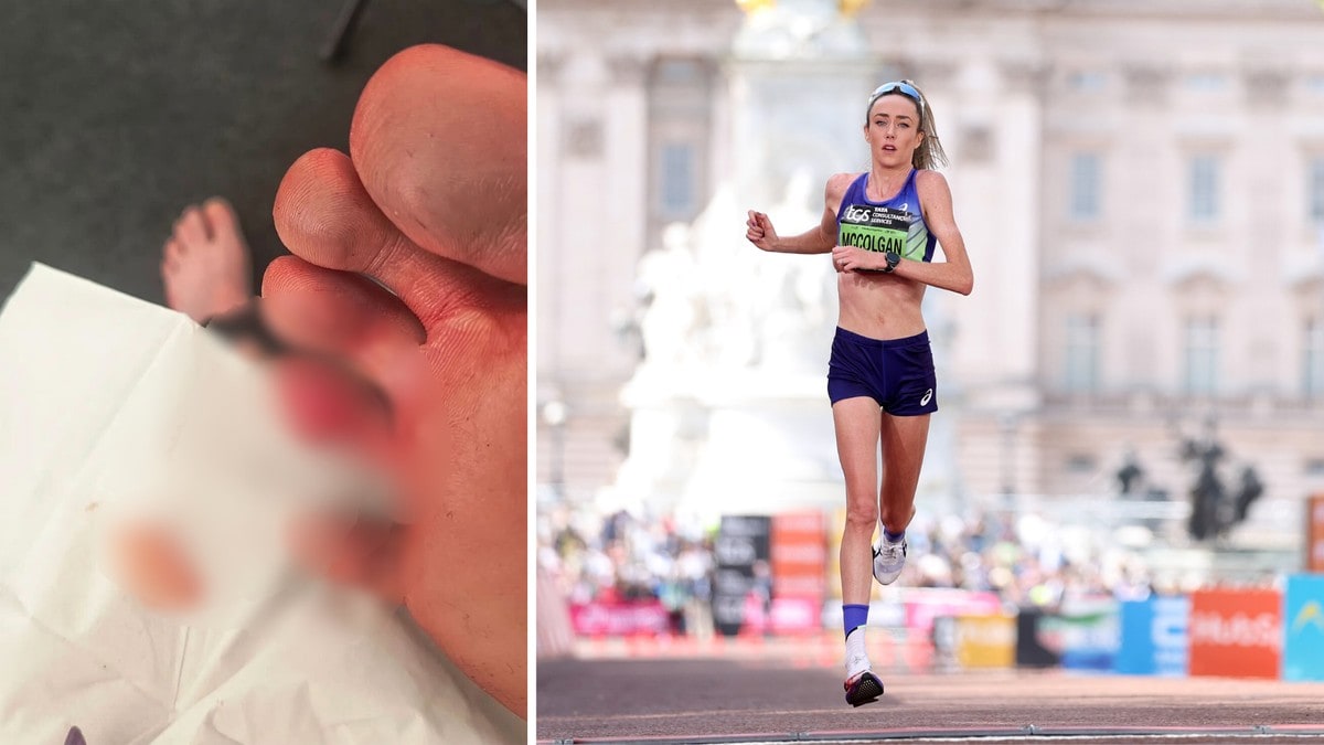 Sprang maraton med «open tå»: – Kjentest ut som foten eksploderte