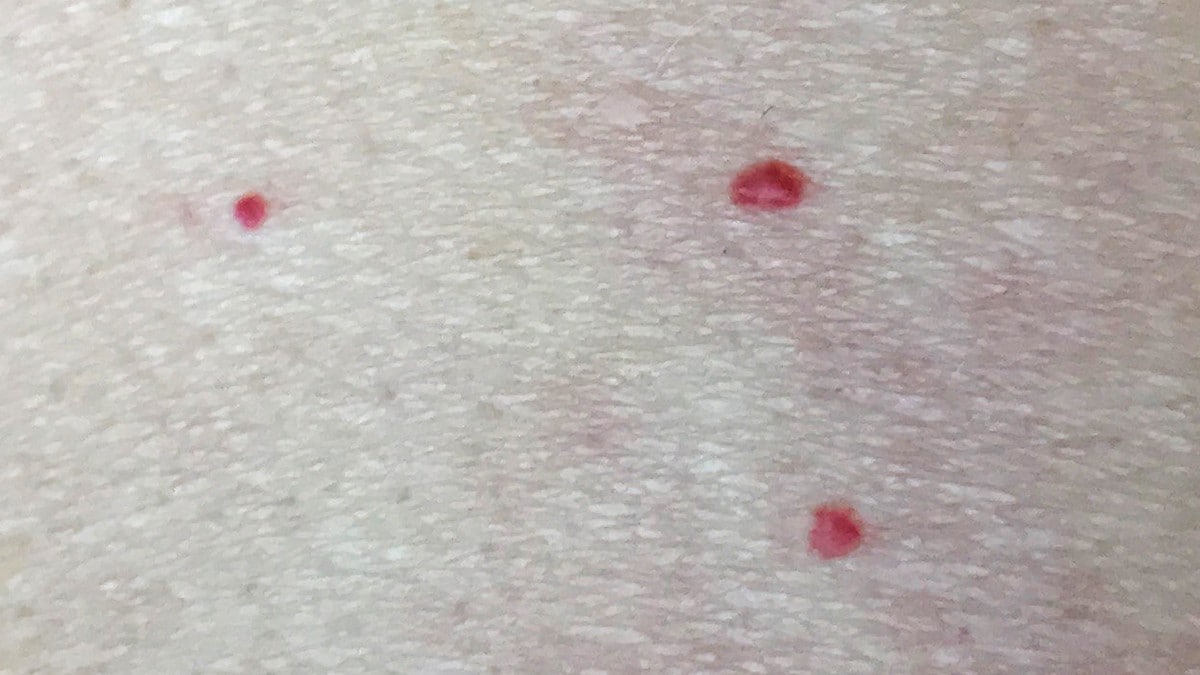 Mange røde prikker på huden? Du kan være ekstra utsatt