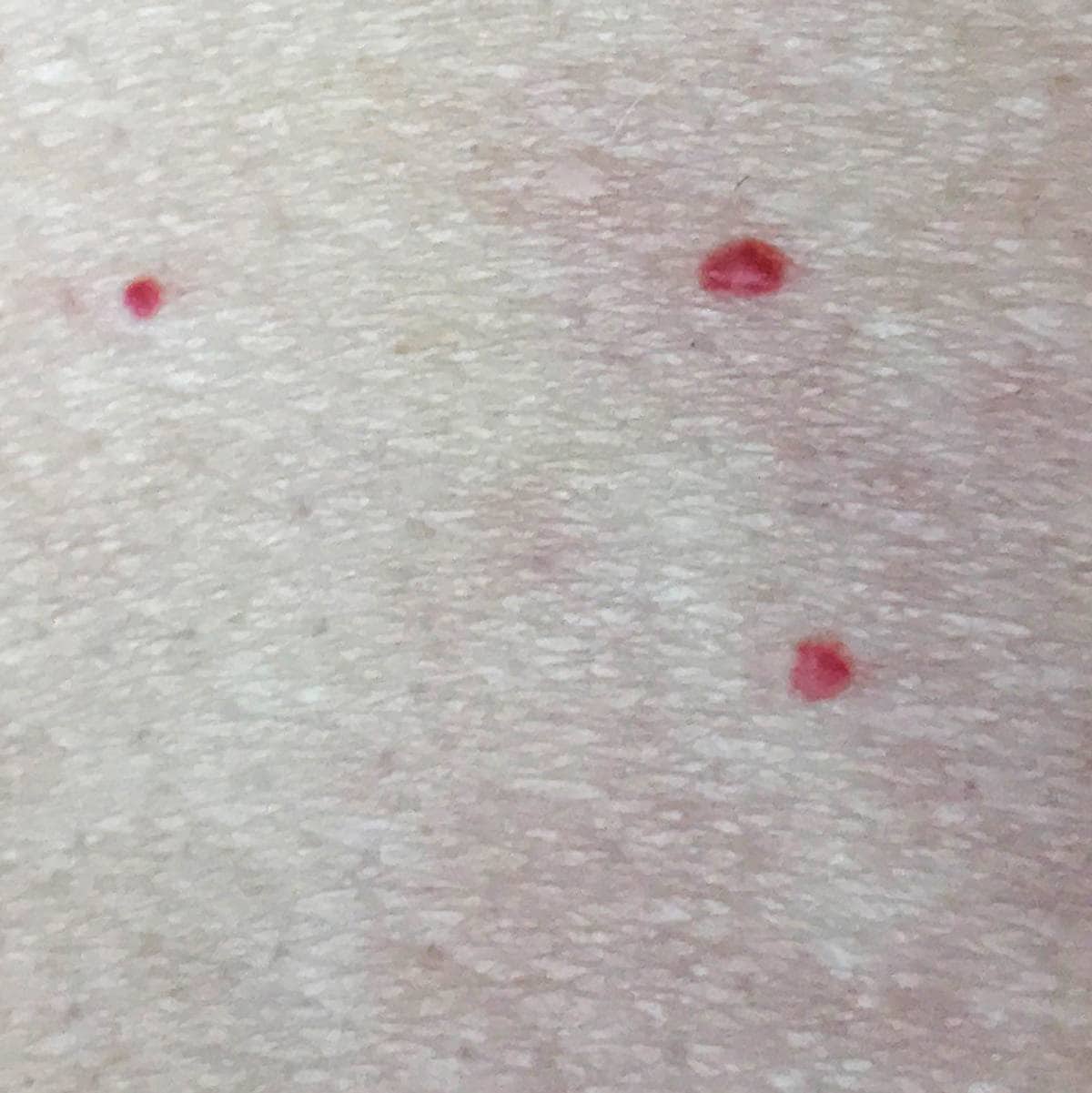 Bitte små røde prikker under huden