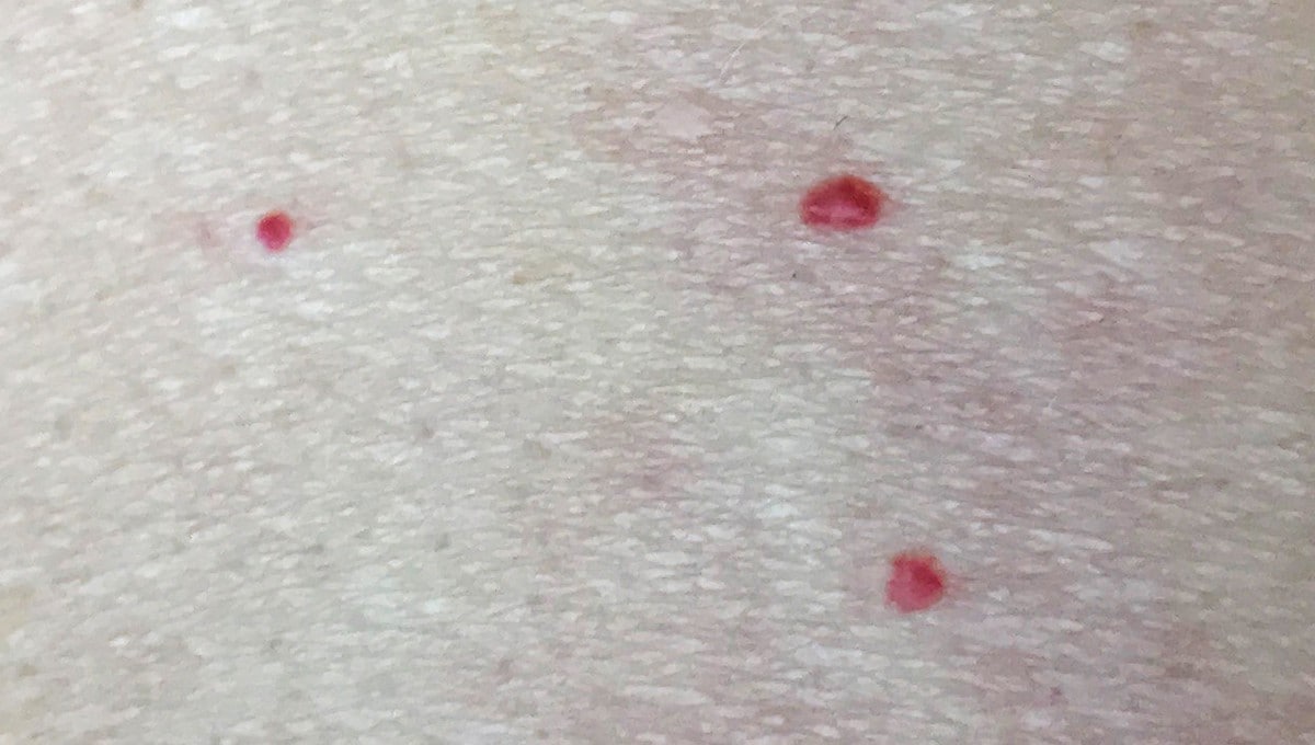 Små røde prikker på huden