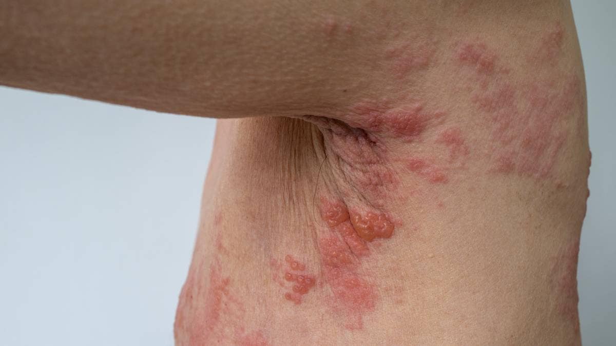 Politisk uenighet om helvetesildvaksinen: – Smerten var grusom