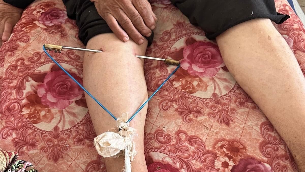 Gaza-sykehus: Leger improviserer med tørkesnor og klemmer
