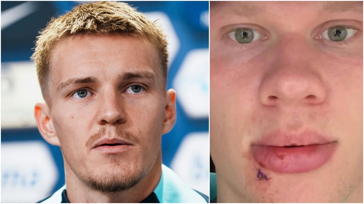 Ødegaard om Haaland-skaden: – Aldri vært borti lignende