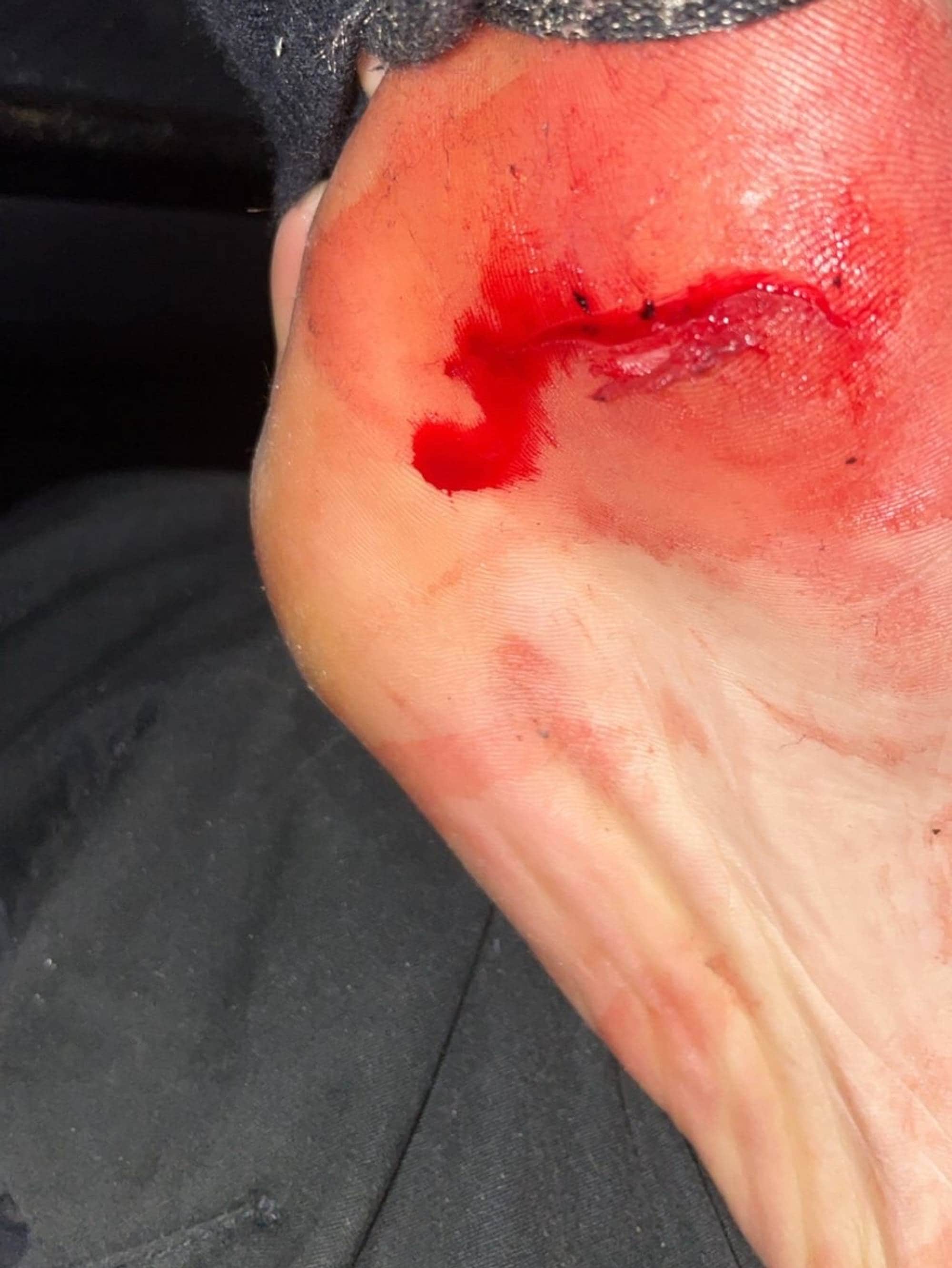 Nærbilde av en menneskefot med et kutt og blod på hælen. (Bildebeskrivelsen er laget av en KI-tjeneste)