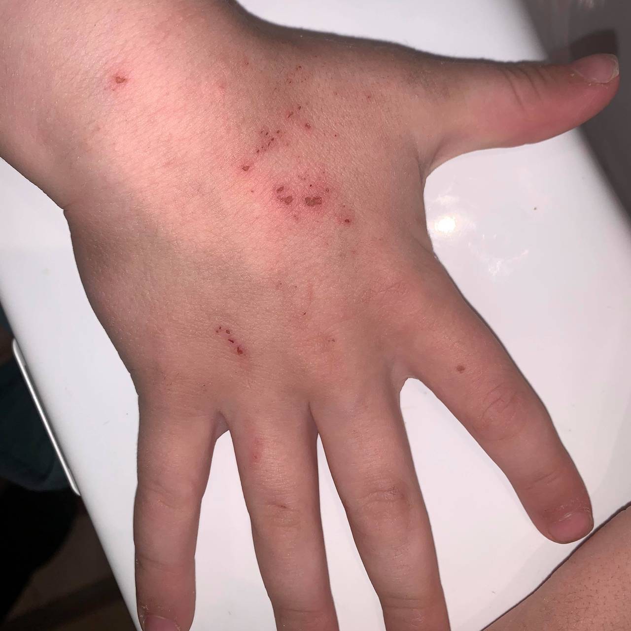 Såre hender som følge av hyppig håndvask.