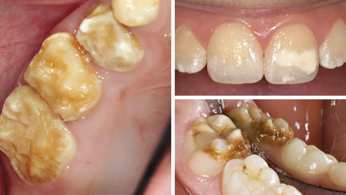 Barns tenner smuldrer opp – finnes ingen kur