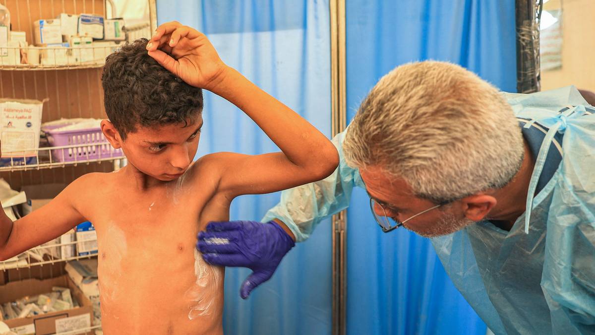Skabb, lus og utslett – hudsjukdommar brer om seg på Gazastripa