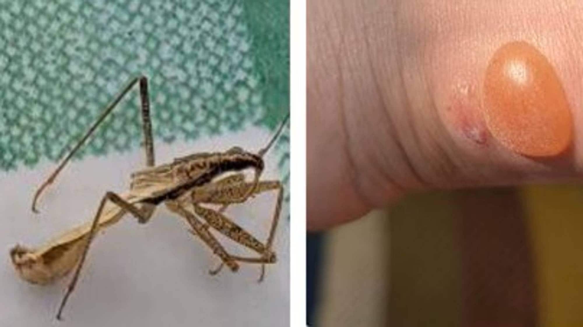 Insektbitt