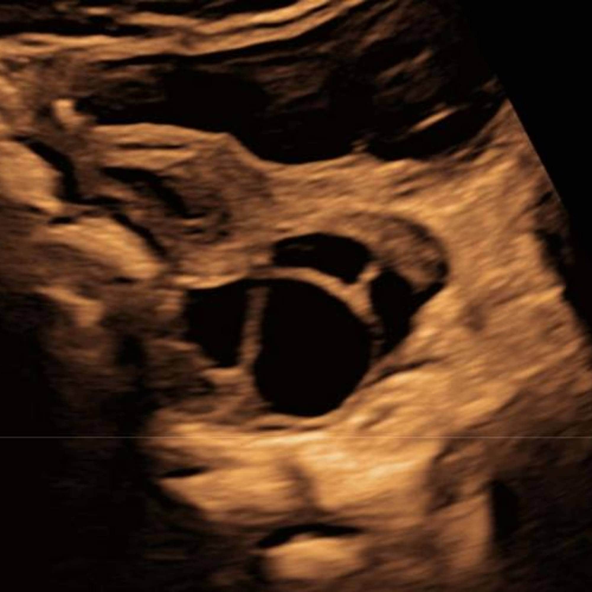 Ultralydbilde av en eggstokk hos en tre måneder gammel baby