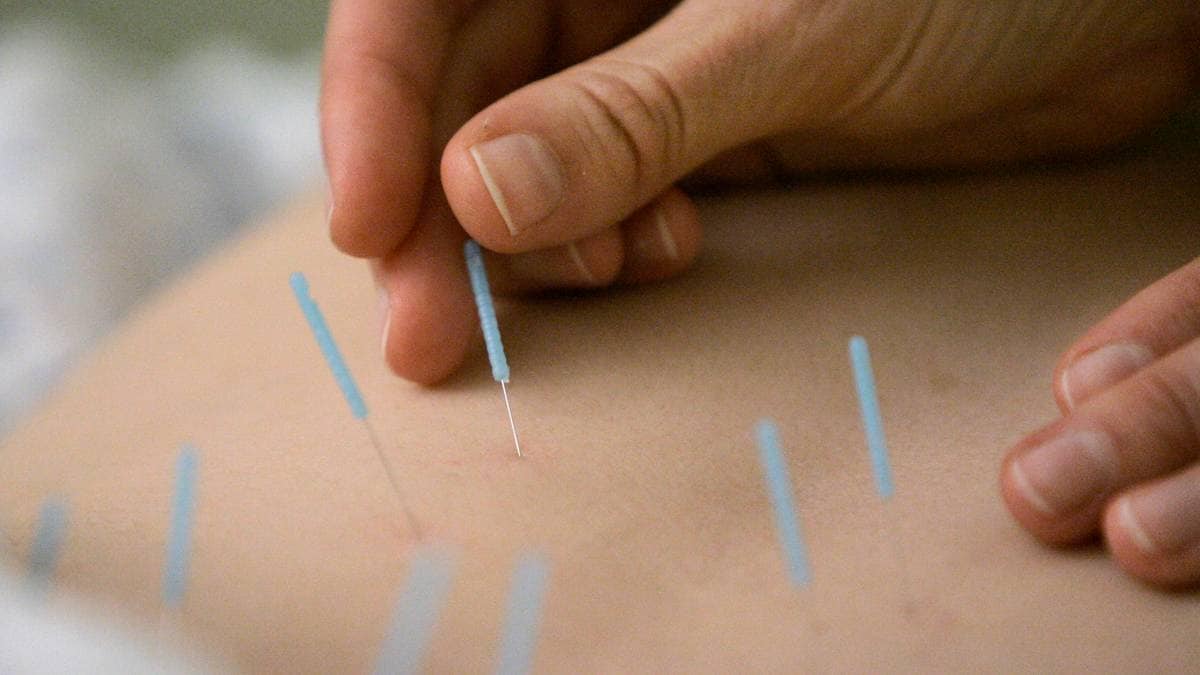 Tok akupunktur – ble sykemeldt i åtte måneder