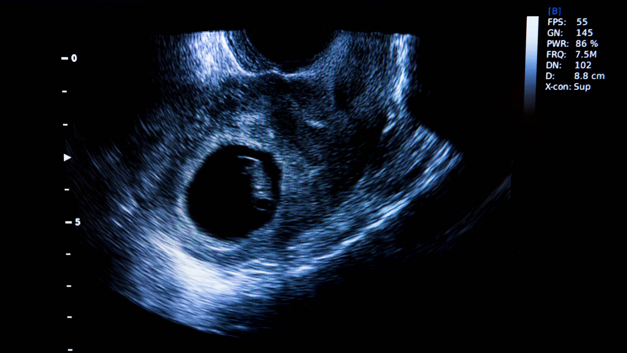 Ultralydbilde fra tidlig i svangerskapet, man kan så vidt skimte et embryo.