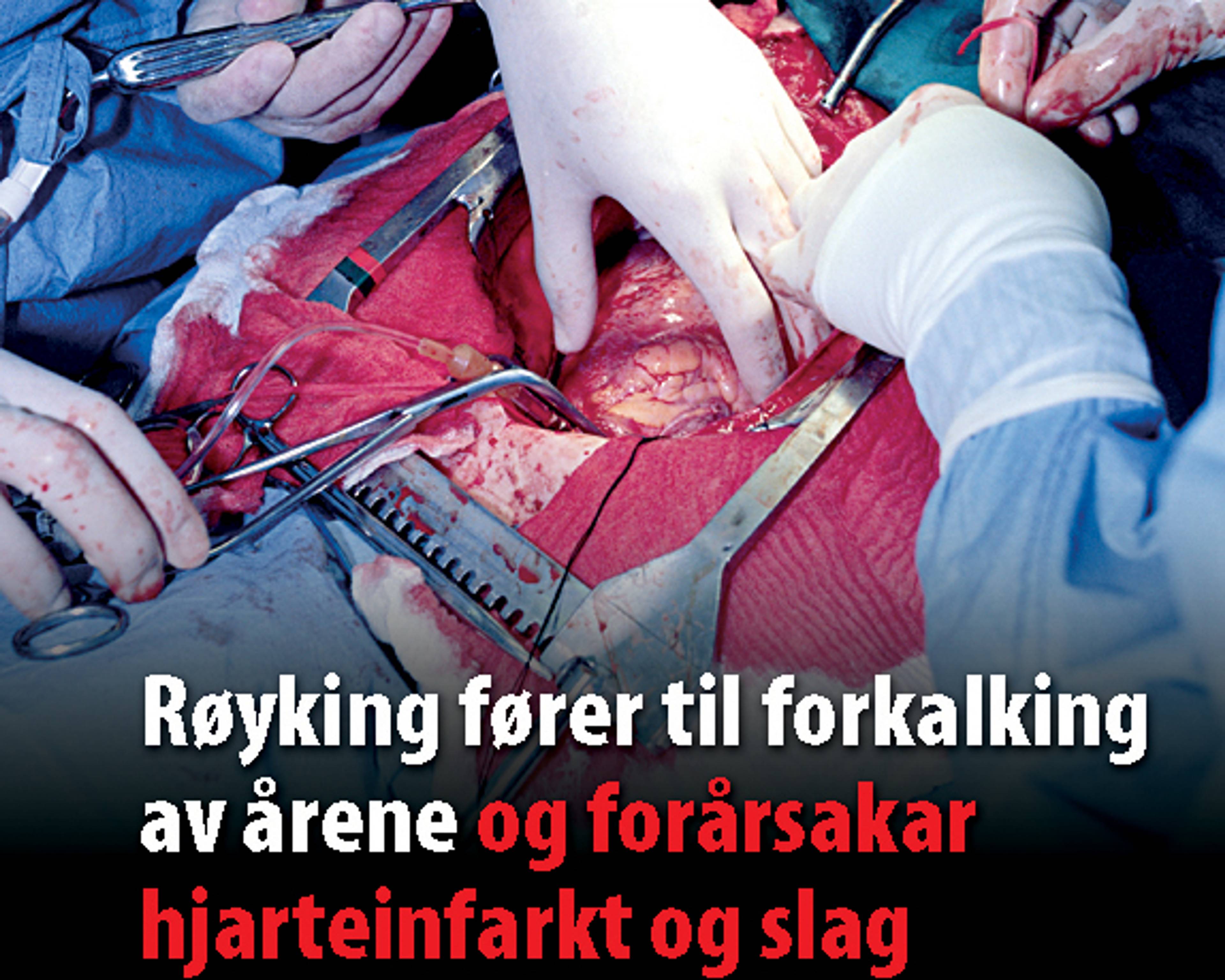Et kirurgisk team utfører en hjerteoperasjon. Hender i sterile hansker bruker kirurgiske instrumenter. Tekst på bildet sier at røyking fører til forkalkning av årene og forårsaker hjerteinfarkt og slag. (Bildebeskrivelsen er laget av en KI-tjeneste)