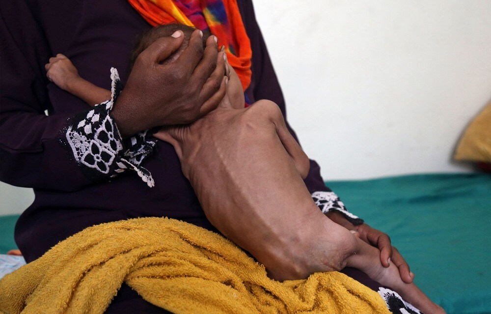 – 85.000 born er døde av svolt i Jemen