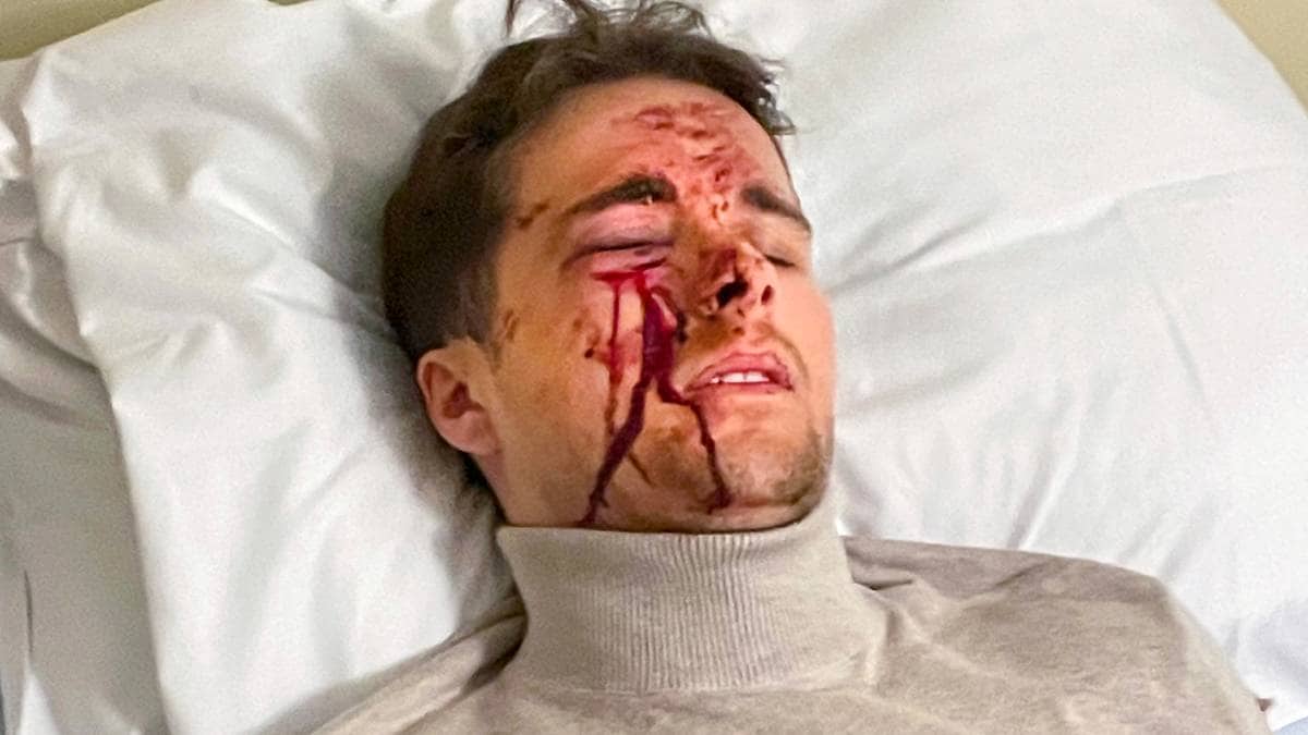 To tenåringar tiltalte for å ha øydelagt synet til Sindre (23) med rakett