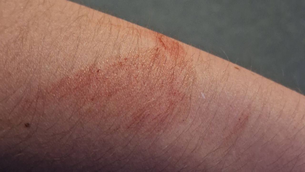 Bilder av armen etter skudd i London pub