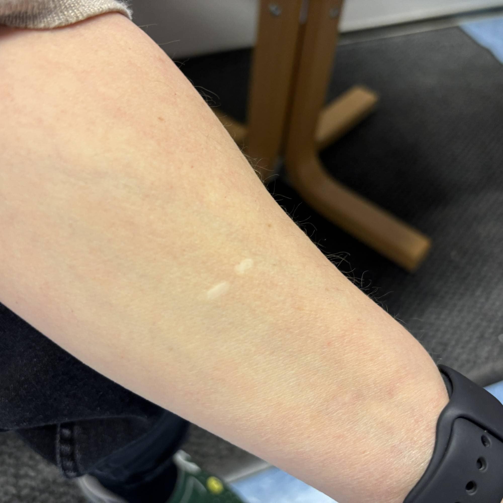 Arr på underarm etter hudbiopsi
