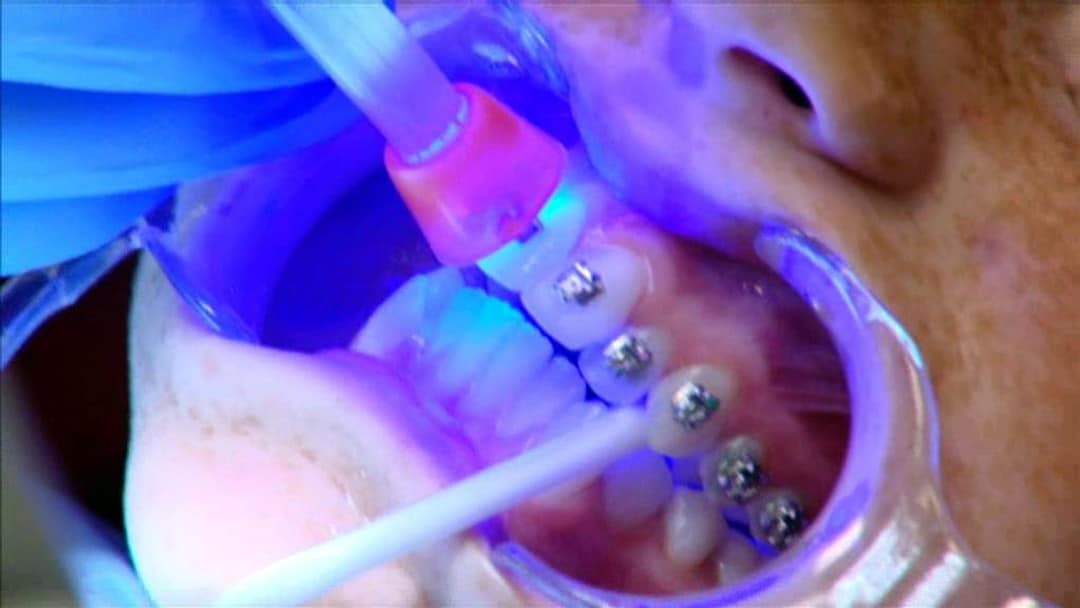 NÆ munn hos tannlegen med regulering, leppene er spilt ut.