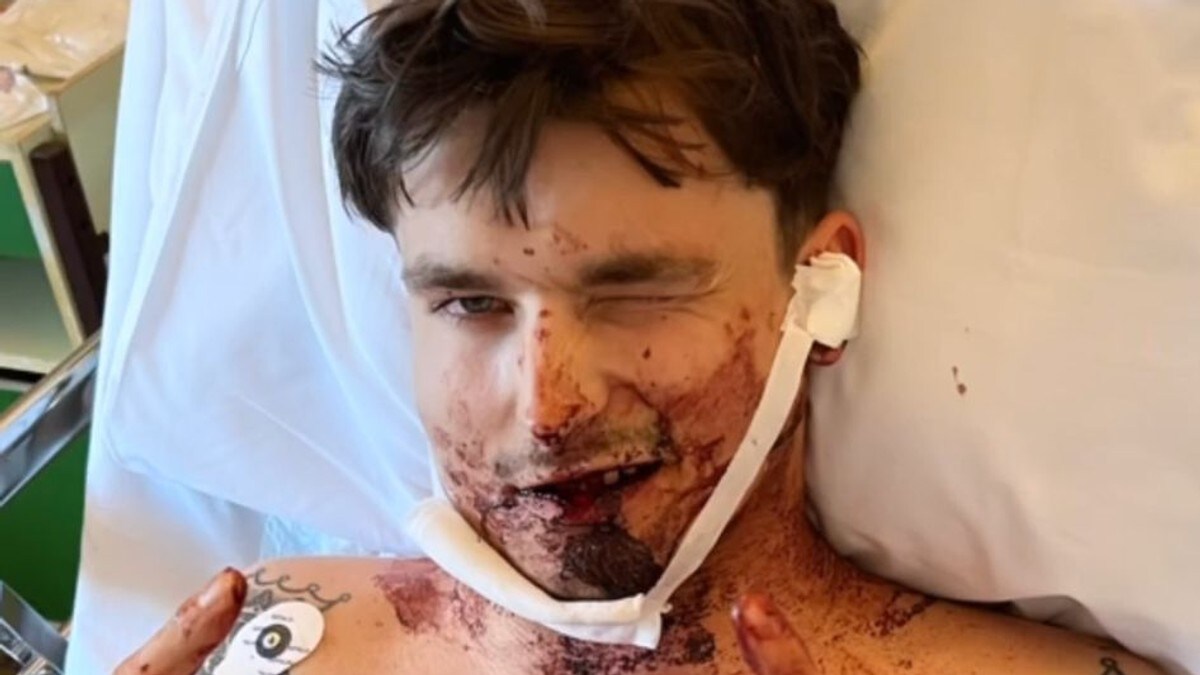 Adrian Sellevoll sykehusinnlagt med brudd i nakke og kjeve etter nattbad-uhell