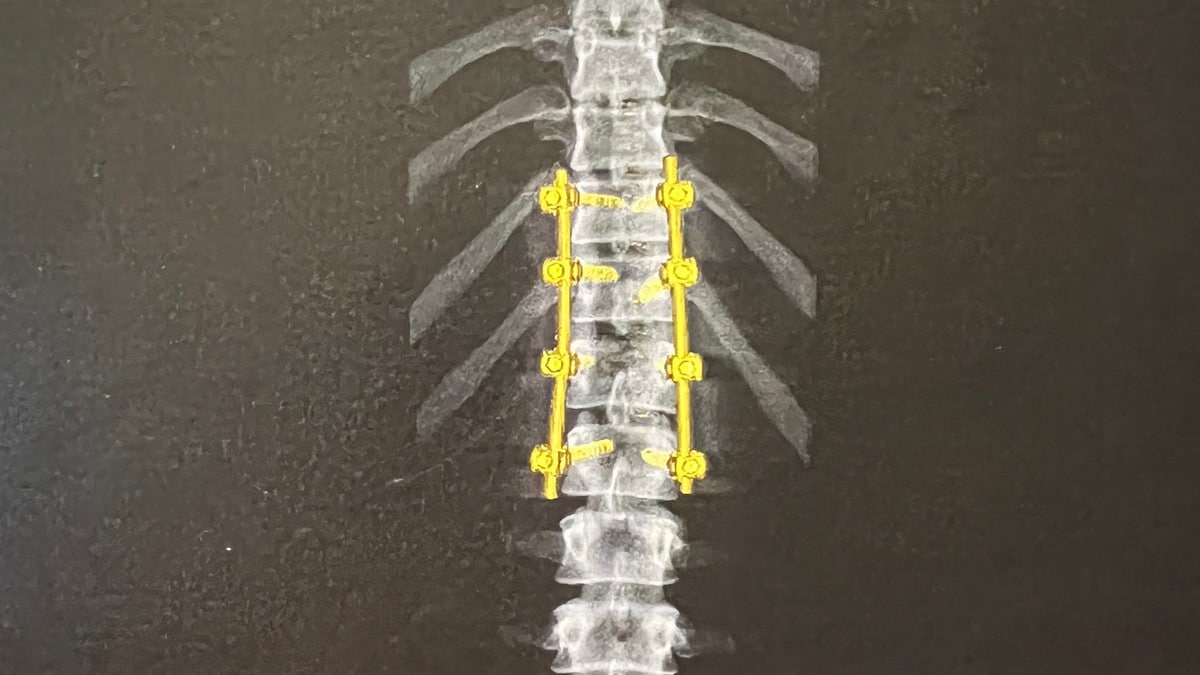 Iselin (17) blei avvist på legevakta med knust ryggvirvel: Ho hadde ikkje ringt først