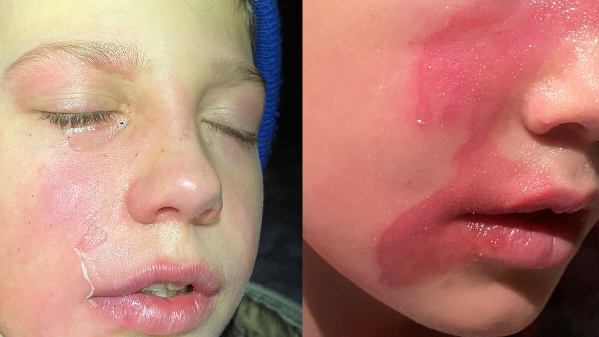 Advarer om brannskader på tur: Jessie Aaron (9) fikk stekefett rett i ansiktet