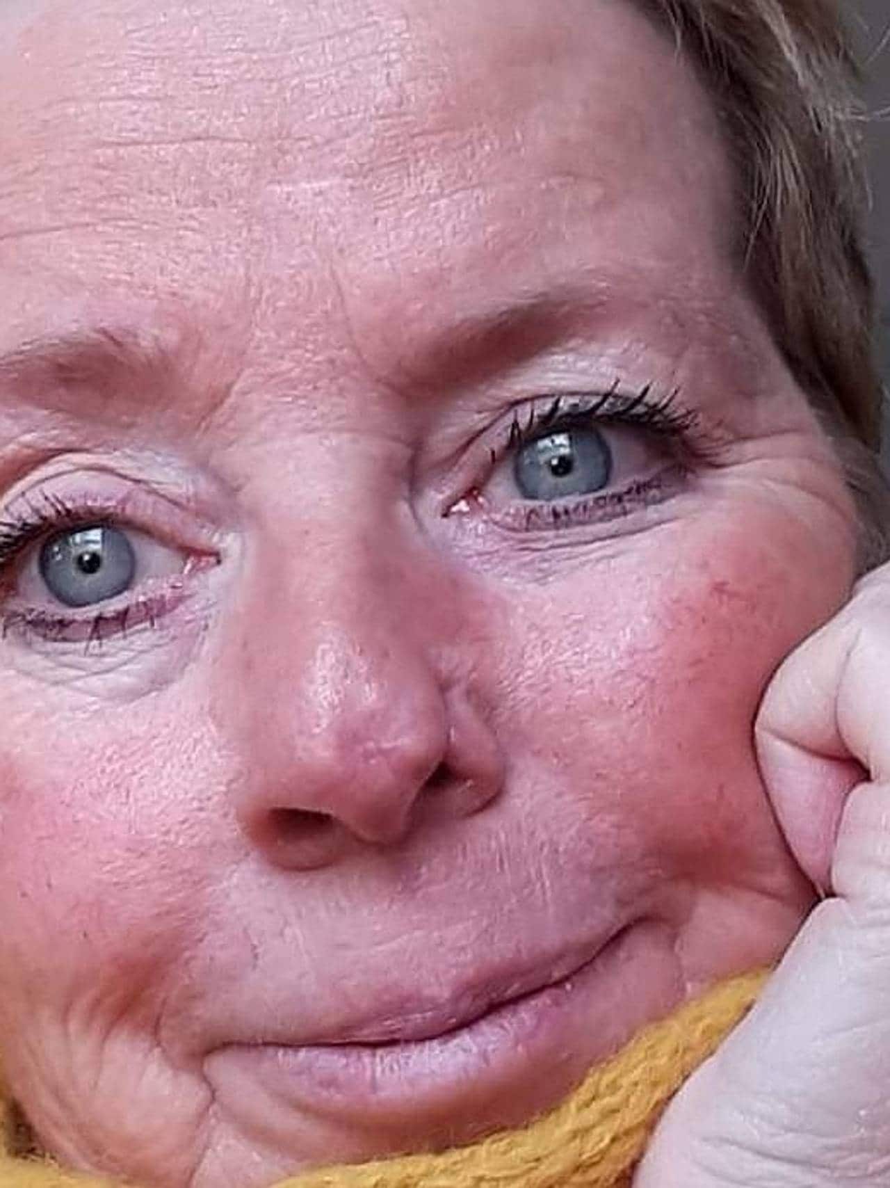 Monica Johansen med deformert nese etter kreftoperasjon