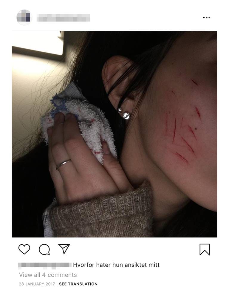 Instagram-bilde av ei jente med selvskadingskutt i ansiktet med teksten "hvorfor hater hun ansiktet"