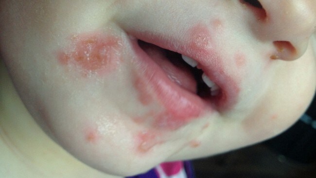 Brennkopper Vitusapotek