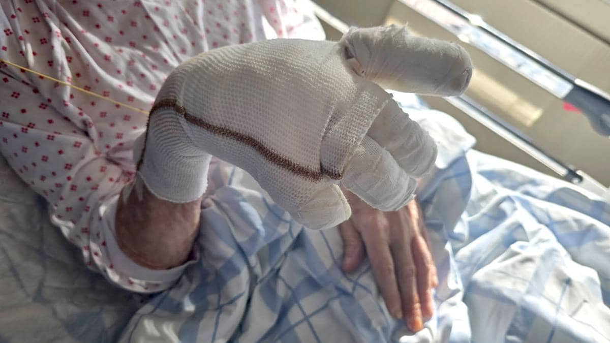 75-åringen skulle ta seg en røyk – endte med brannskader