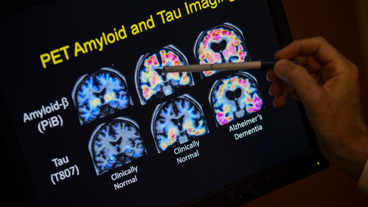 EUs legemiddelbyrå har godkjent Alzheimer-medisin