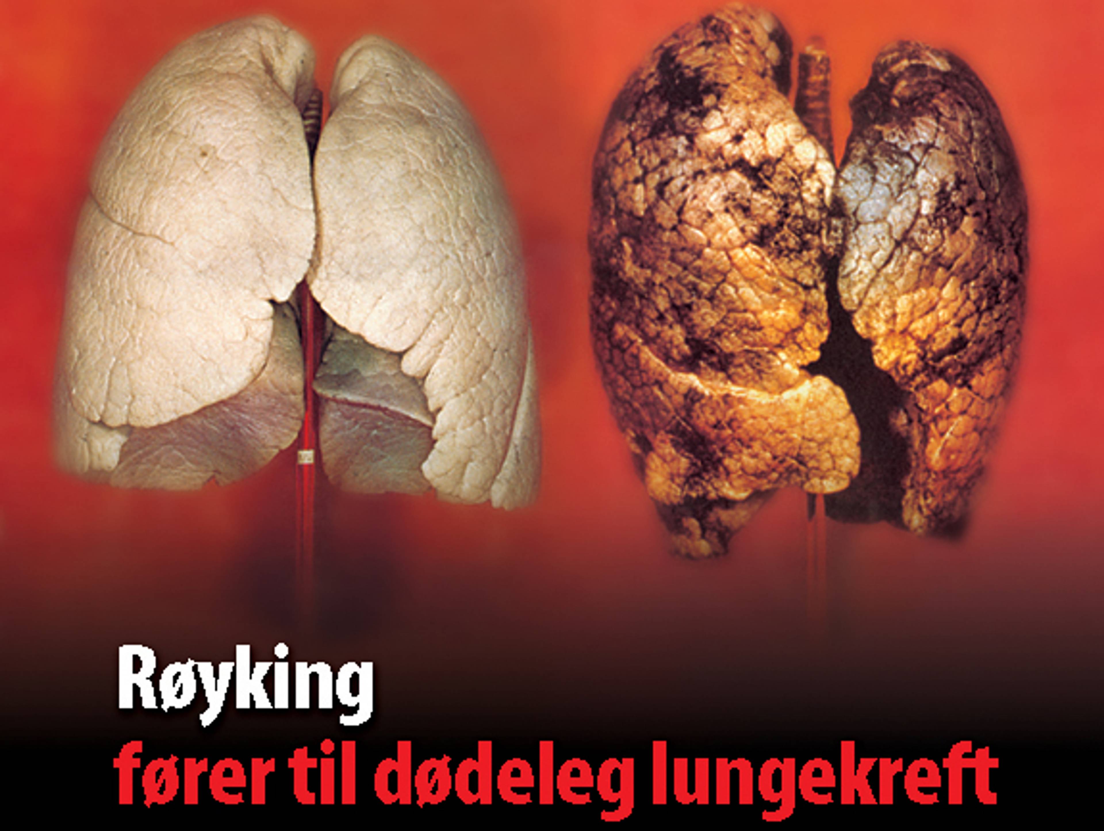 Bilde av to sett med lunger. Det ene settet er friskt og rosa, mens det andre er mørkt og skadet. En tekst på bildet sier "Røyking fører til dødeleg lungekreft". (Bildebeskrivelsen er laget av en KI-tjeneste)
