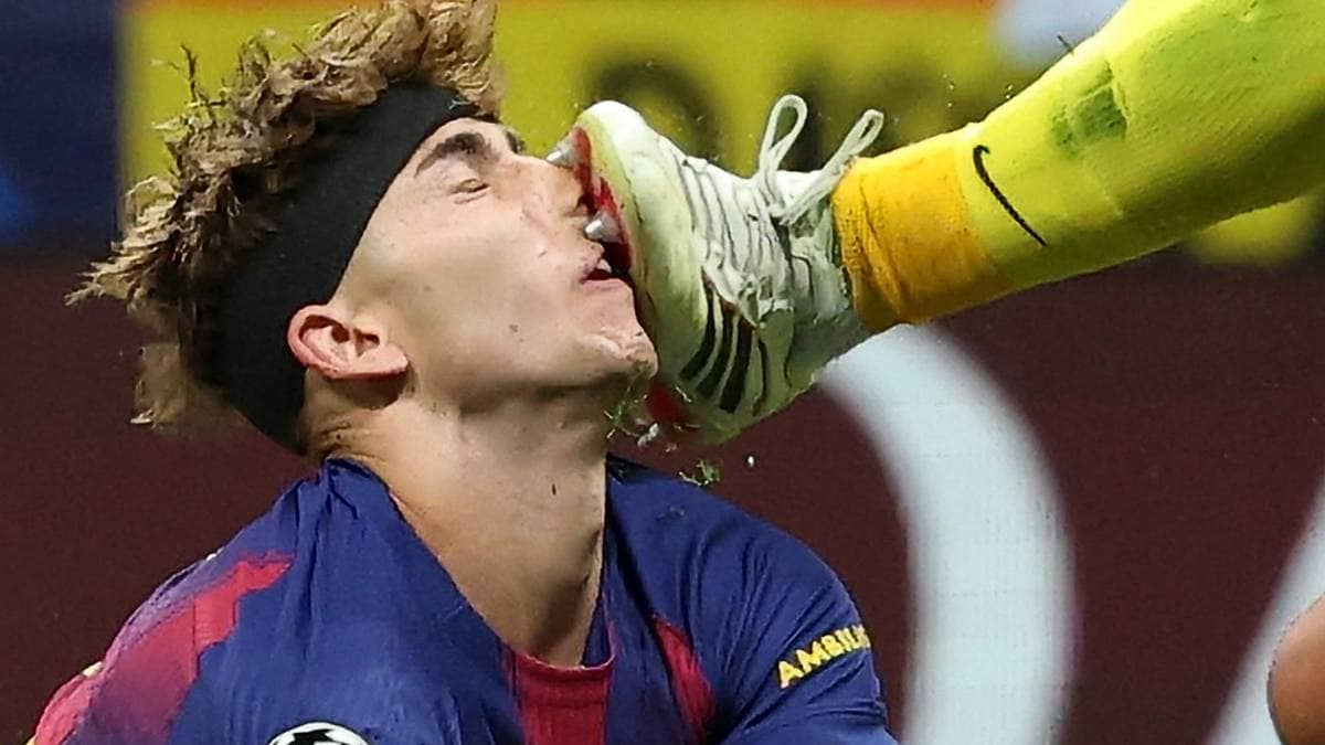 Flere stygge skader i Mesterligaen: Her blir han stemplet i ansiktet med metall-knotter