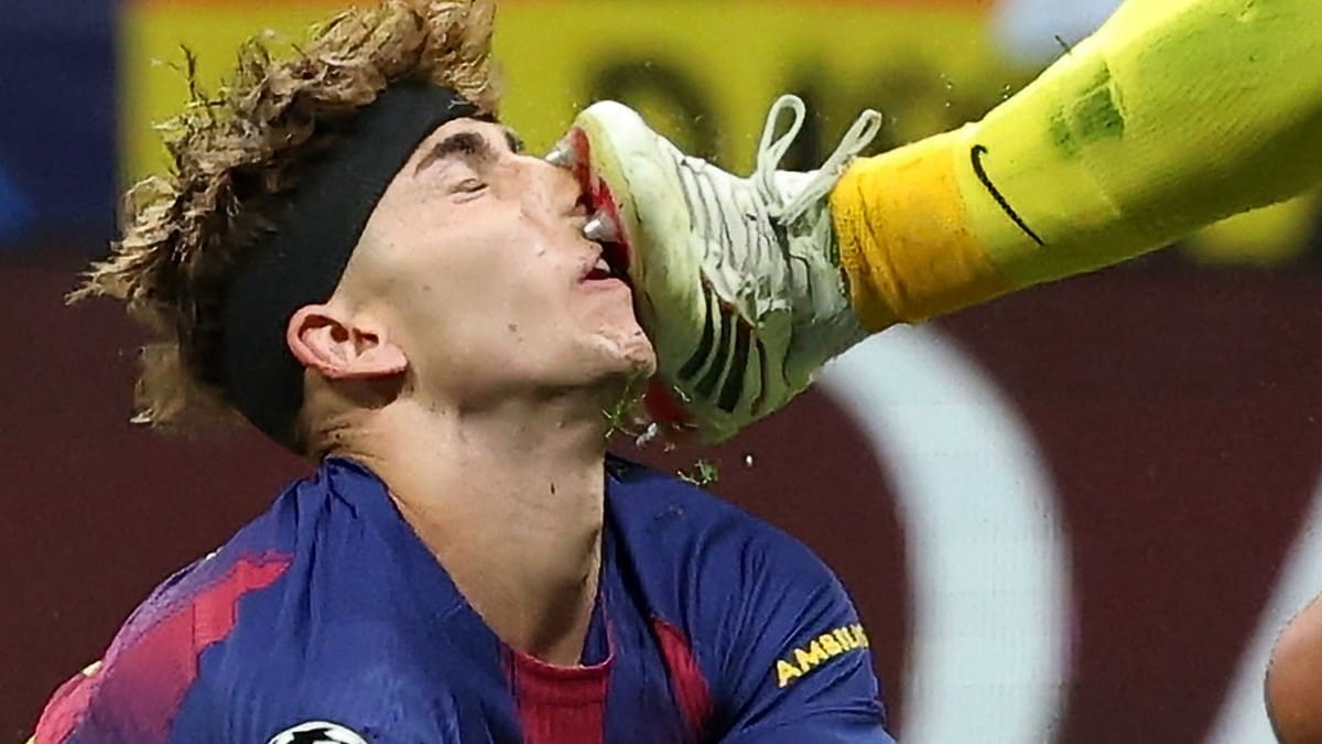 Flere stygge skader i Mesterligaen: Her blir han stemplet i ansiktet med metall-knotter