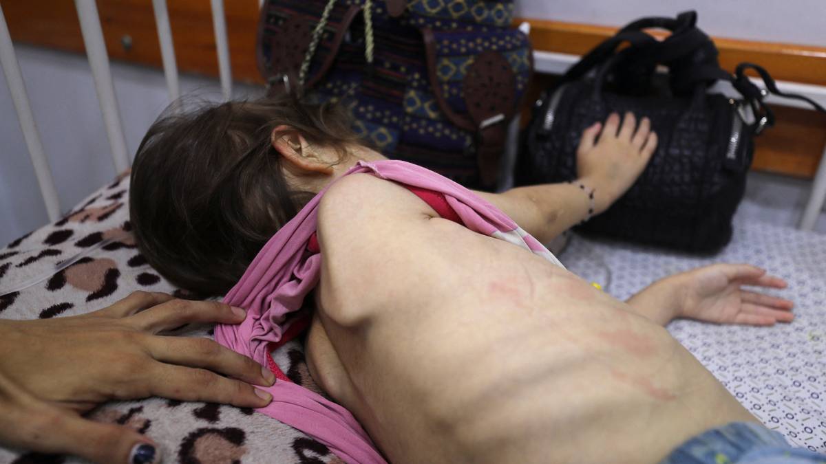Helsemyndighetene i Gaza: 197 personer har sultet i hjel