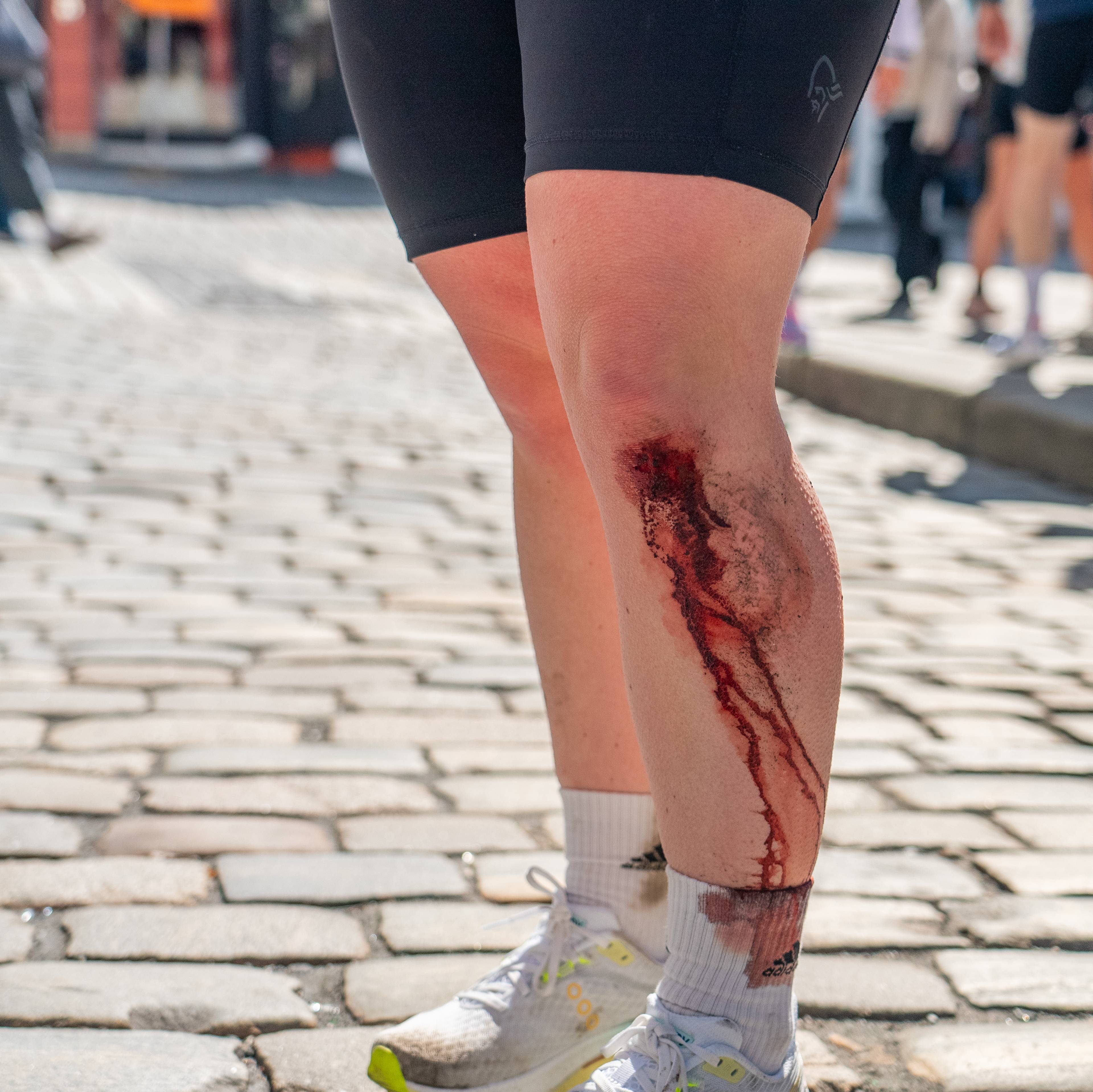 Skadd og blødande kne under Bergen City Marathon 2026